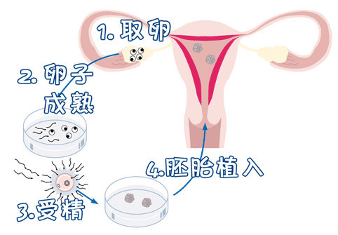 妇科微创